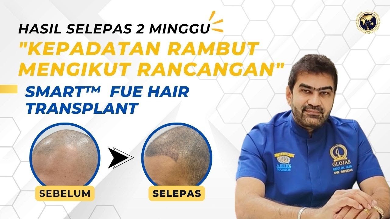 Tanam Rambut SMART™ FUE: Hasil Kepadatan Rambut Selepas 2 Minggu
