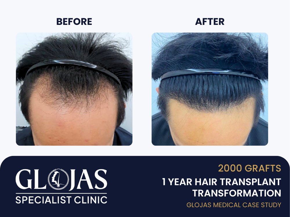 Kajian Kes: Tanam Rambut FUE dengan 2,000 Graft – Hasil 1 Tahun untuk Botak Lelaki Tahap 3