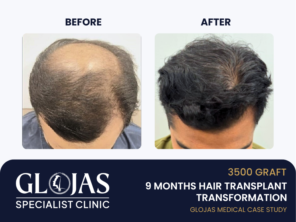 Kajian Kes: Tanam Rambut FUE – Hasil Selepas 9 Bulan dengan 3,500 Graft untuk Keguguran Rambut Lelaki Tahap 4 11 tanam-rambut-9-bulan