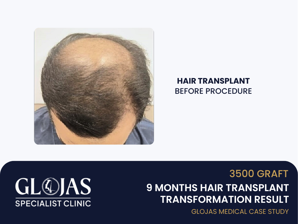 hair-transplant-before
