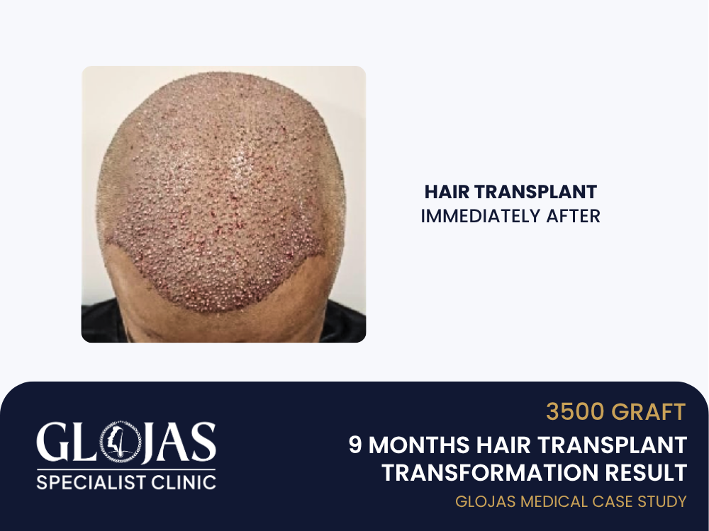 hair-transplant-immediately-after