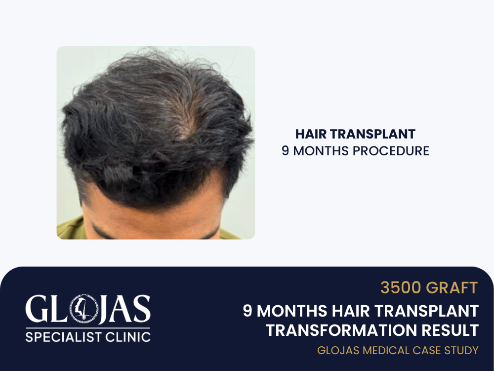hair-transplant-9-months