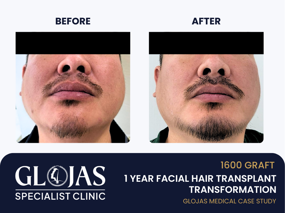 Kajian Kes: Tanam Bulu Muka – 1,600 Graft untuk Misai & Janggut (Hasil 1 Tahun)
