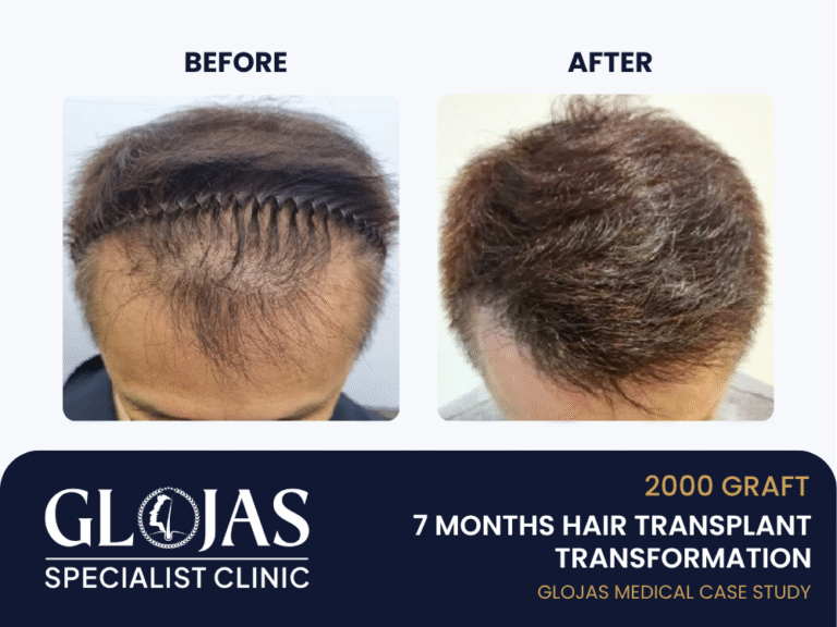 tanam-rambut-7-bulan