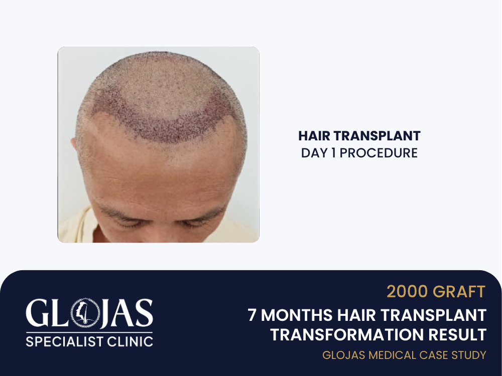 tanam-rambut-hari-1