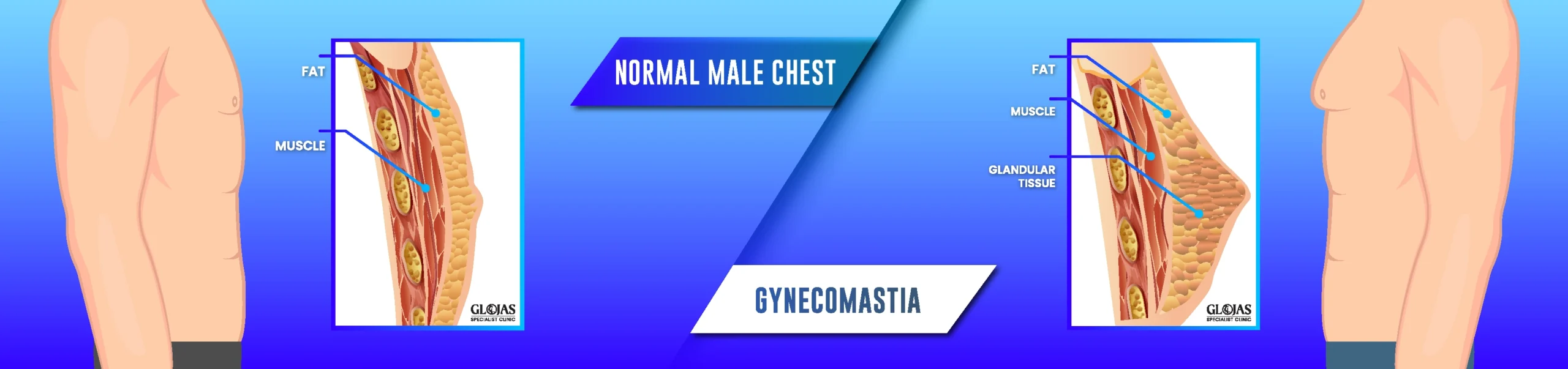gynecomastia-surgery-malaysia