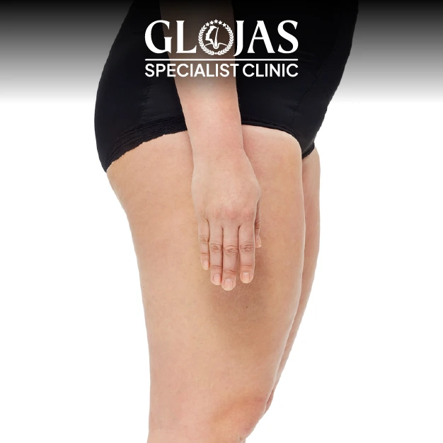 Liposuction before after 21