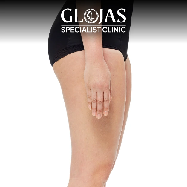 Liposuction before after 22