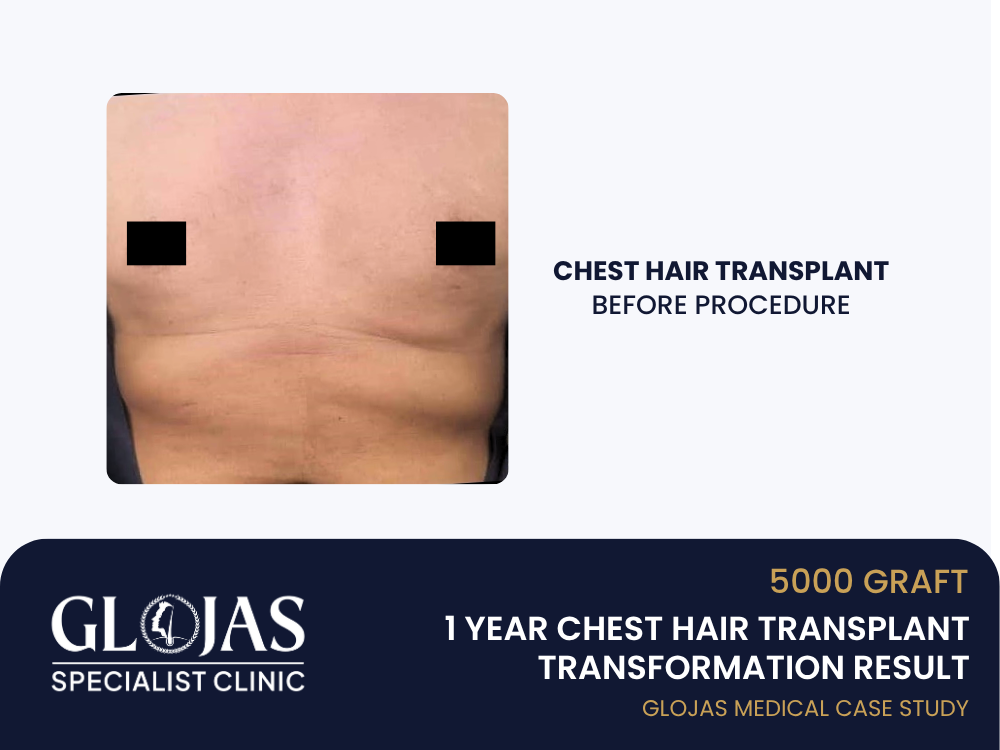chest-hair-transplant-1-year