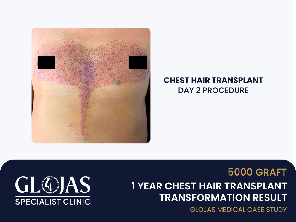 chest-hair-transplant-day-2