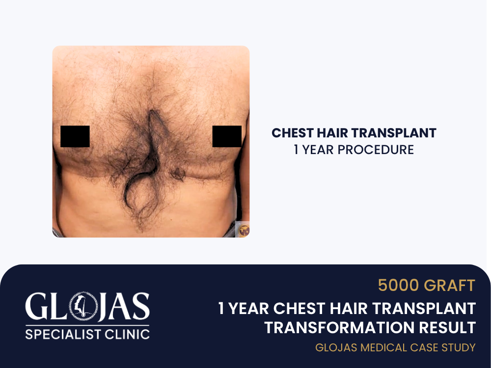 chest-hair-transplant-1-year