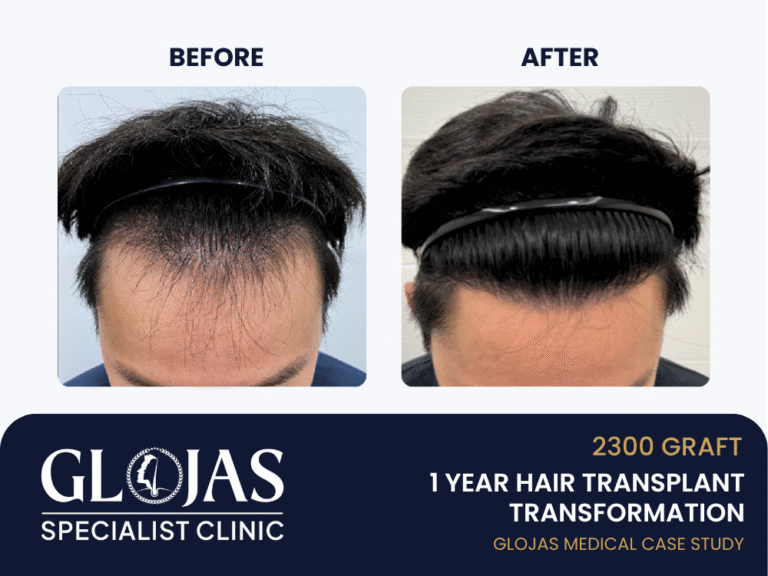 tanam-rambut-hasil-1-tahun
