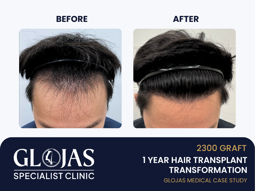 Kajian Kes: Tanam Rambut – 2,300 Graft untuk Lelaki dengan Garis Rambut Surut (Hasil 1 Tahun) 19 tanam-rambut-hasil-1-tahun