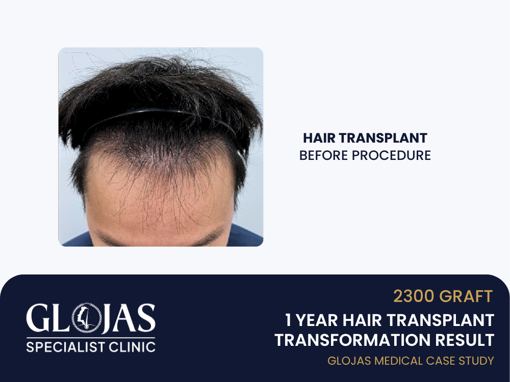 hair-transplant-before
