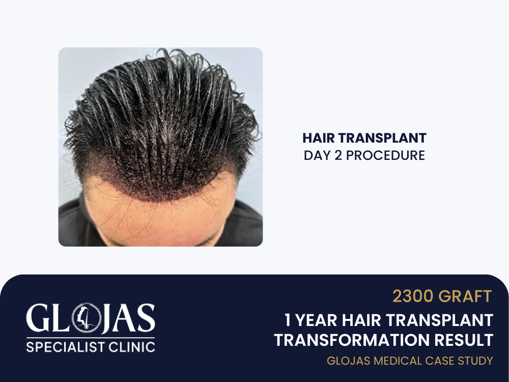 hair-transplant-day-2
