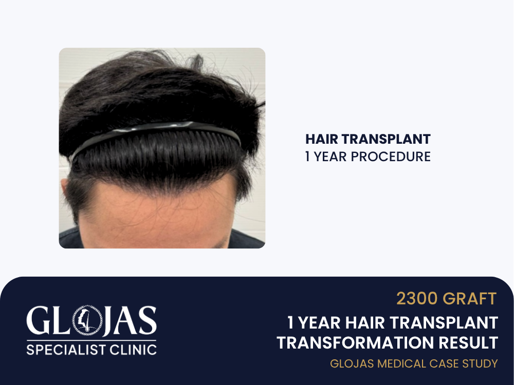 hair-transplant-1-year