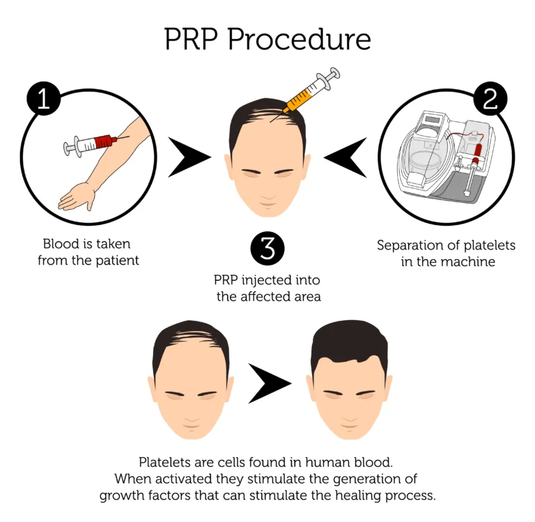 prp hair loss injection malaysia
