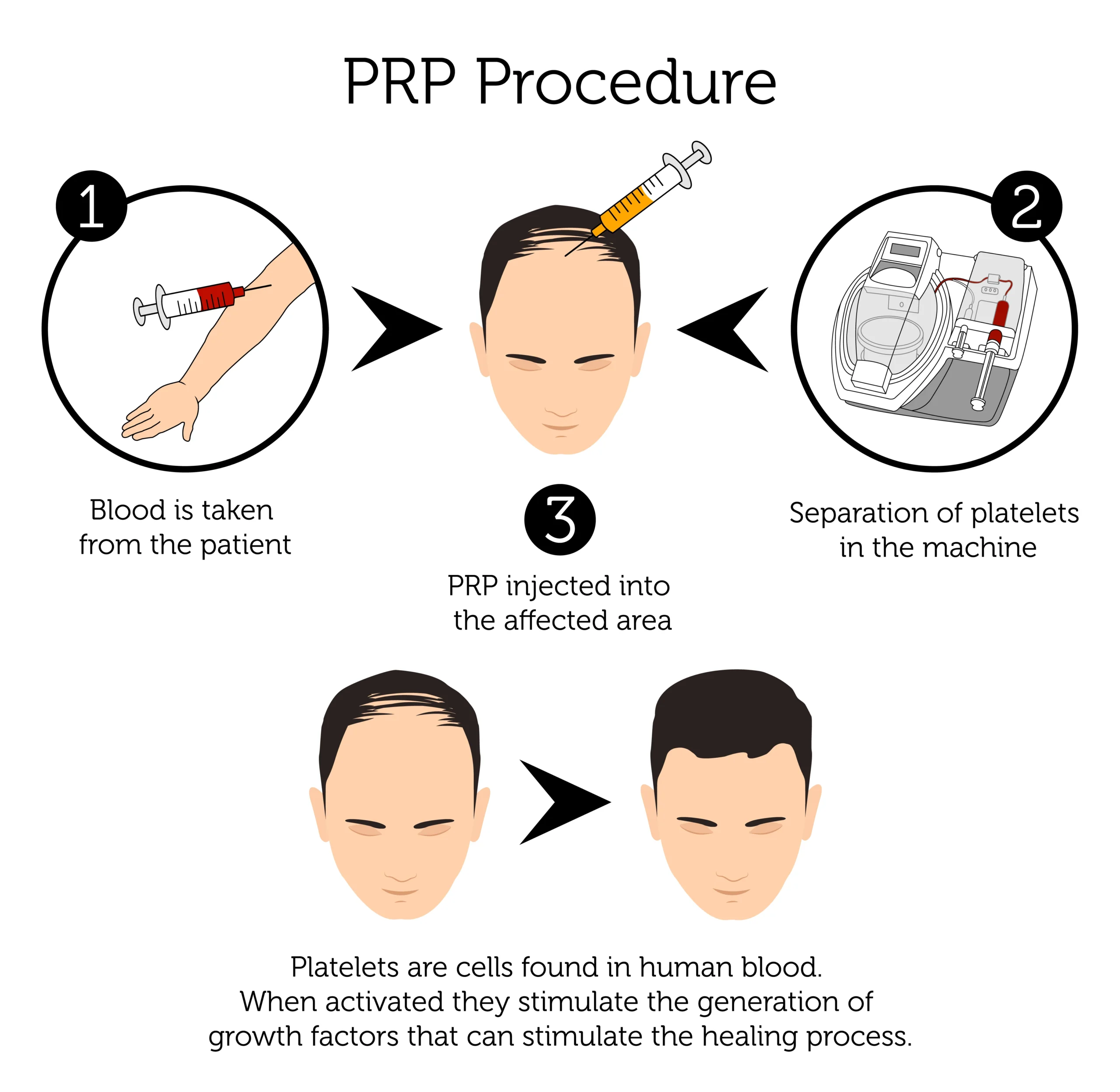hair-loss-treatment-PRP-therapy
