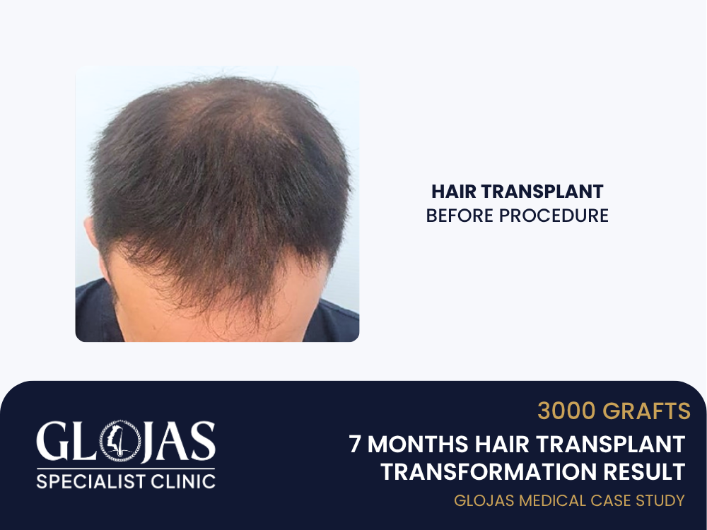 tanam-rambut-sebelum
