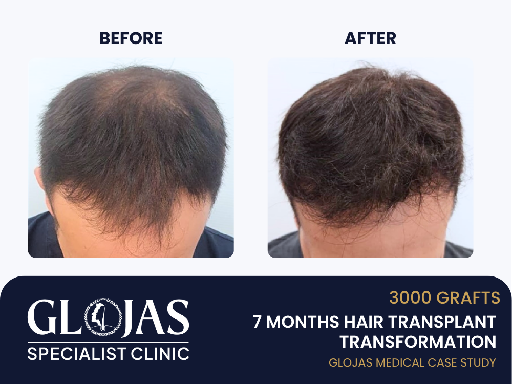 Kajian Kes: Tanam Rambut – 3,000 Graft untuk Masalah Botak Lelaki Tahap 3–4 (Hasil 7 Bulan)