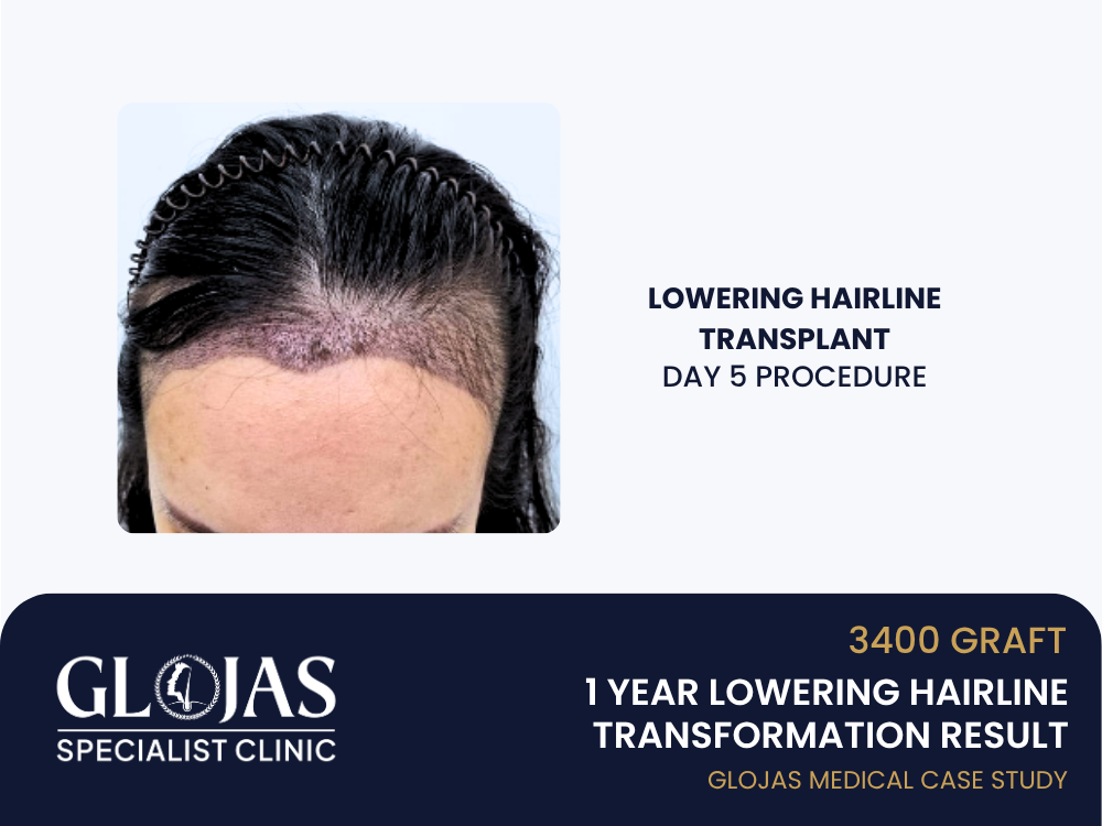 hairline-transplant-day-5