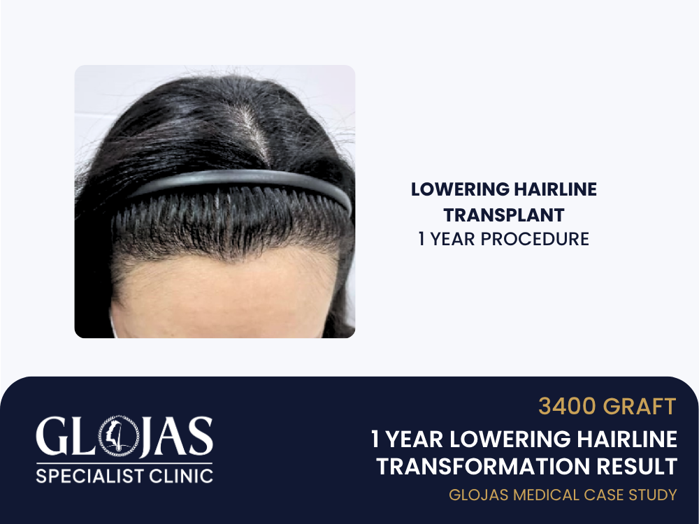 hairline-transplant-1-year