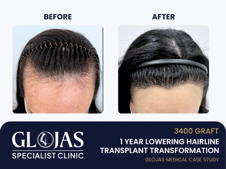 hairline-transplant