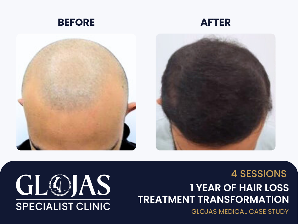 Kajian Kes: Perjalanan Rawatan Rambut Nipis Lelaki – 4 Sesi Selama 1 Tahun