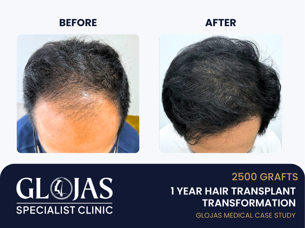 Kajian Kes: Tanam Rambut – 2,500 Graft untuk Botak Lelaki Tahap 3 (Hasil 1 Tahun)