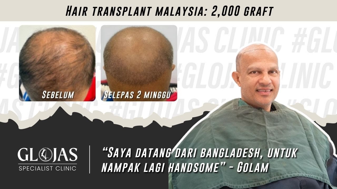 Hair Transplant in Malaysia | Tanam Rambut 2000 Graf: Transformasi Rambut M-Shape