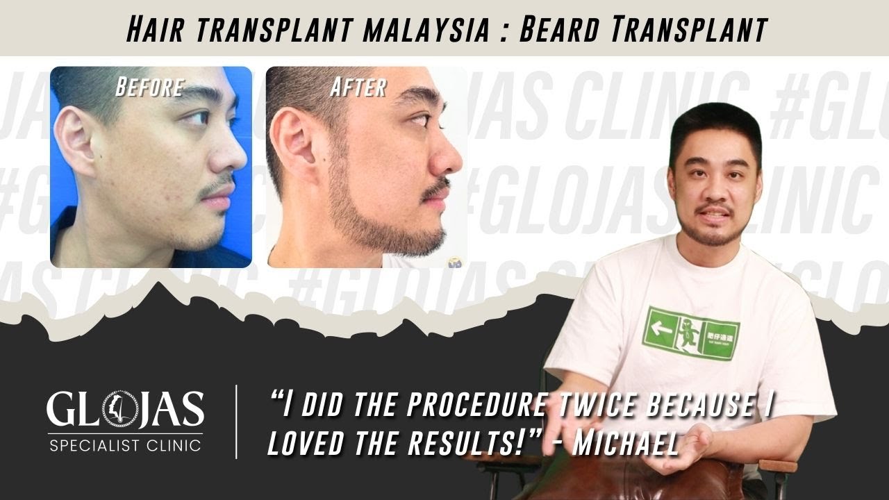 Hair Transplant in Malaysia | Best Results & Cost of Beard Transplant in Malaysia | 8 Years Later