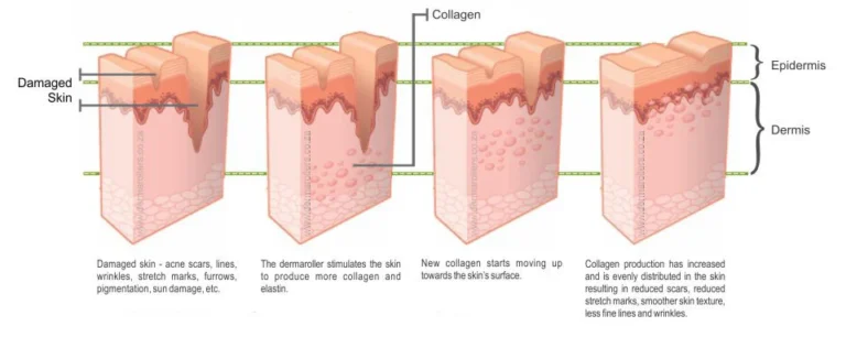 dermaroller how it works
