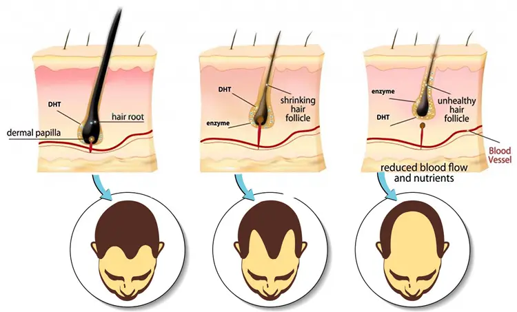 dht-blocker-hair-loss