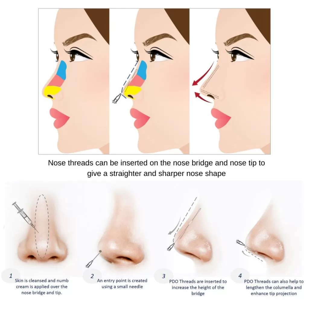 Nose-Thread-Lift