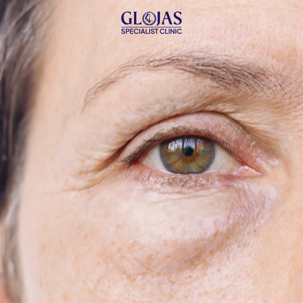 endolift laser treatment Artboard 5