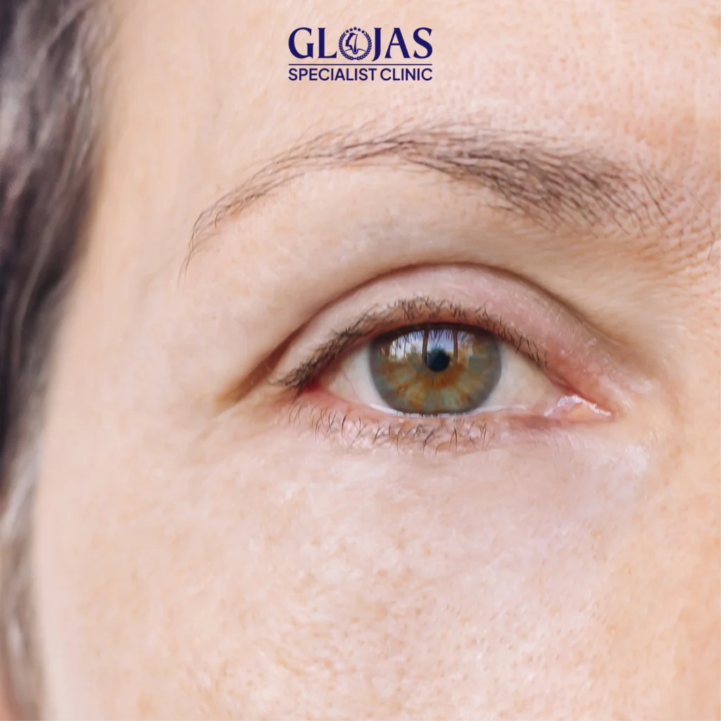 endolift laser treatment Artboard 6