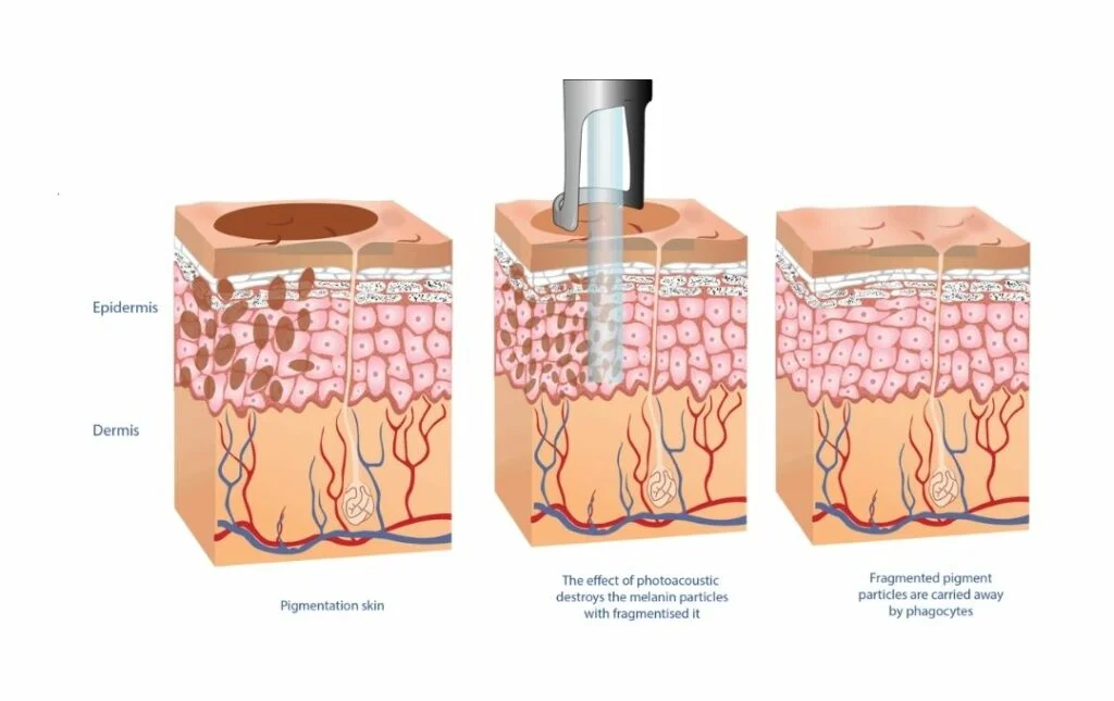 Pico Laser Malaysia: Everything You MUST Know in 2026 1 pico-laser-treatment-malaysia