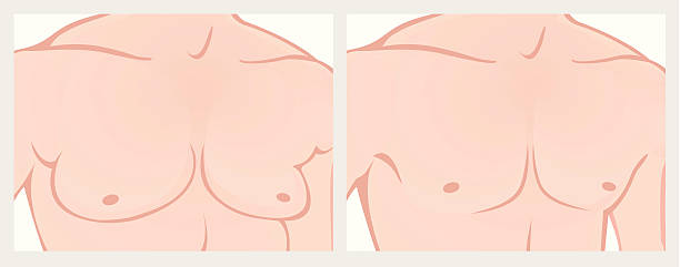 gynecomastia-surgery-clinic-before-after-man-boobs