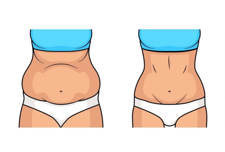 liposuction-fat-removal-weight-loss-certified-plastic-surgeon-clinic-malaysia