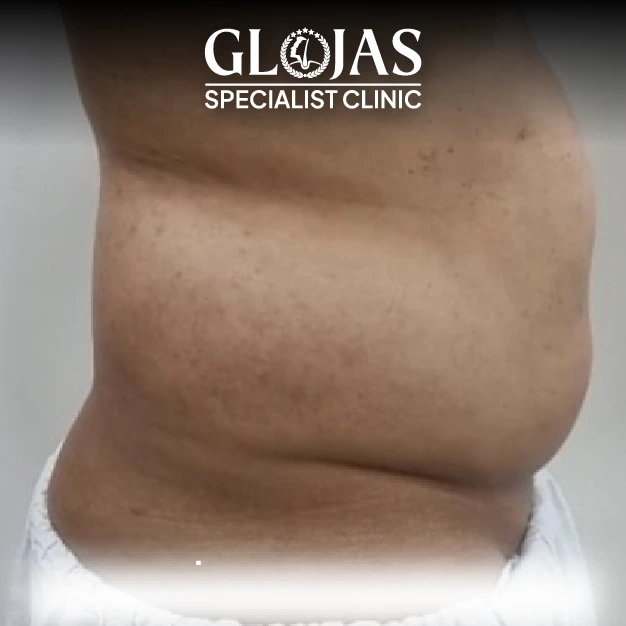 liposuction before after 15