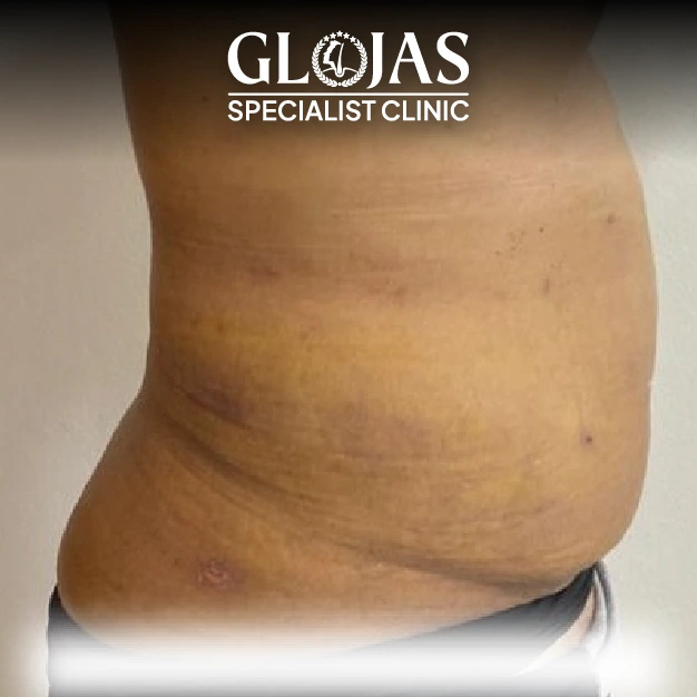 liposuction before after 16