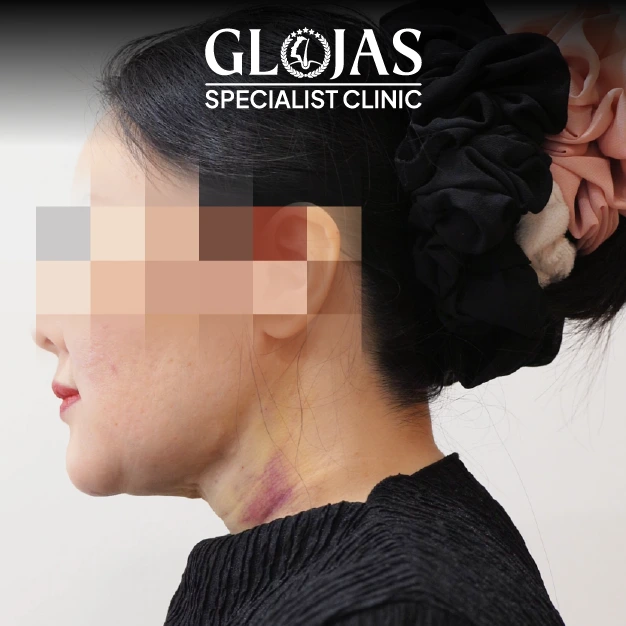 liposuction before after 19