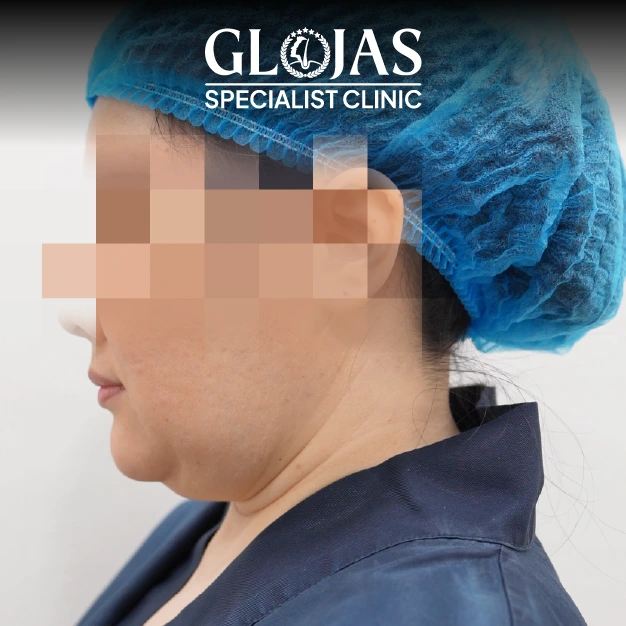 liposuction before after 20
