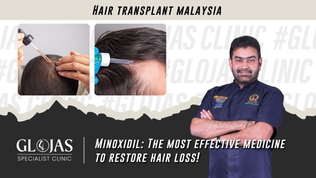 Hair Transplant in Malaysia | Best Results & Cost | Minoxidil: A Proven Solution for Hair Loss 1 hair-loss-minoxidil