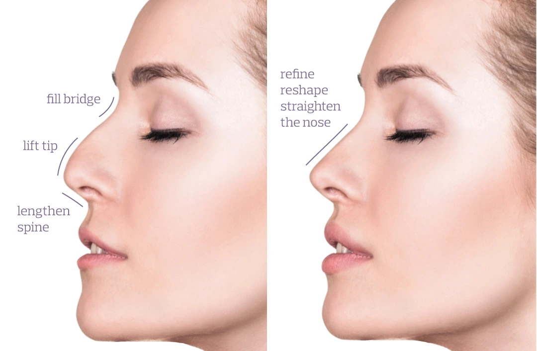Nose-Thread-Lift