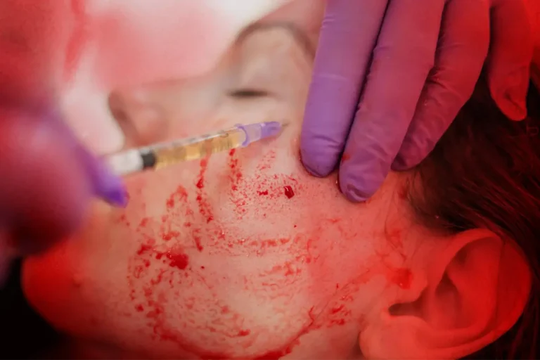 prp-facial-injection-acne-treatment-malaysia