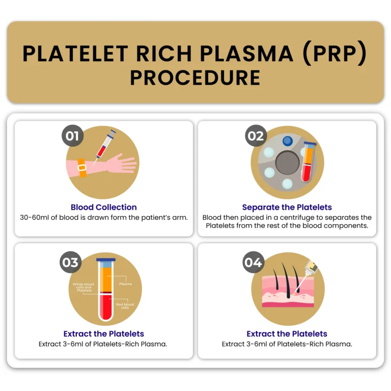 prp procedure 01 1