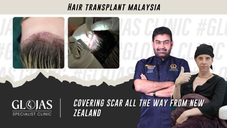 hair-transplant-scar