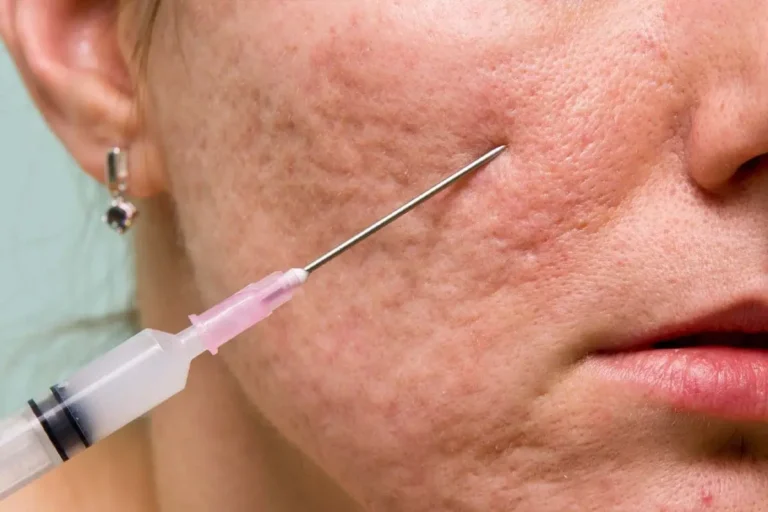 subcision-acne-treatment-malaysia