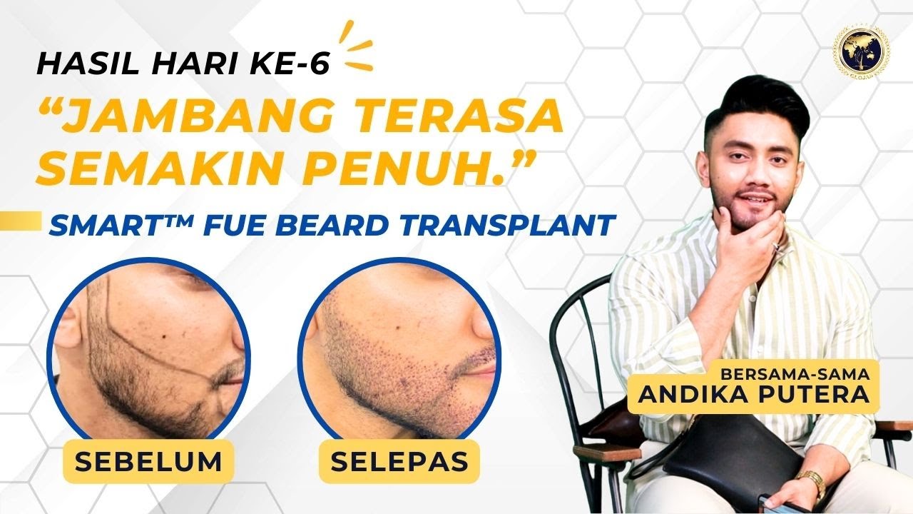 Tanam Rambut Malaysia | Hasil Terbaik & Kos Tanam Rambut Malaysia | Tanam Jambang: Hasil Hari 6